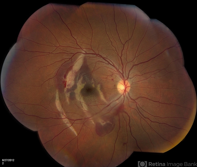 Choiroidal Rupture Choroidal Rupture - Retina Image Bank