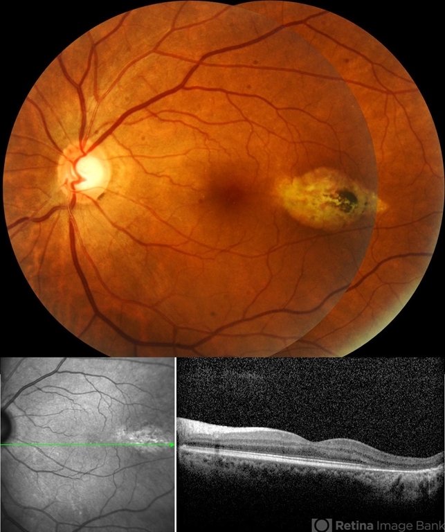 Torpedo Maculopathy - Retina Image Bank