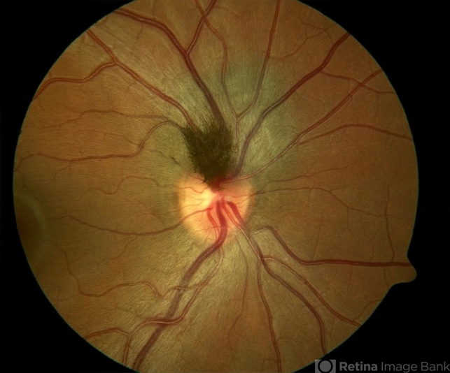 Melanocytoma - Retina Image Bank