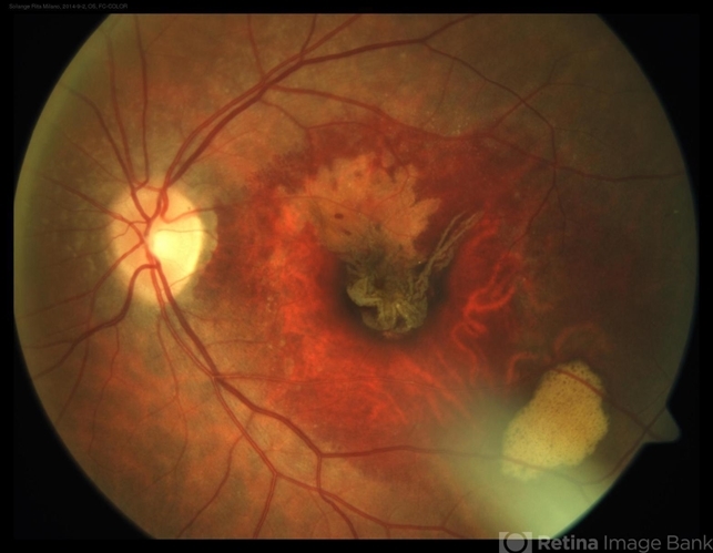 RPE Tear After Anti-VEGF Injection - Retina Image Bank