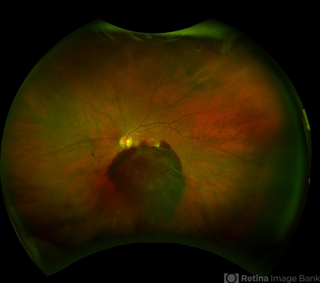 Choroidal Neovascular Membrane Evolving With Subretinal Hemorrhage