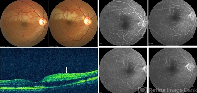 Branch Retinal Artery Occlusion - Retina Image Bank