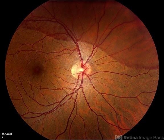 Donut-Shaped Subhyaloidal Hemorrhage - Retina Today