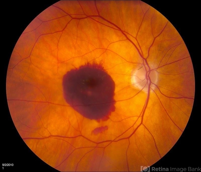 Retinal Hemorrhage - Retina Image Bank