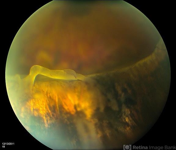 Giant Retinal Tear - Retina Image Bank