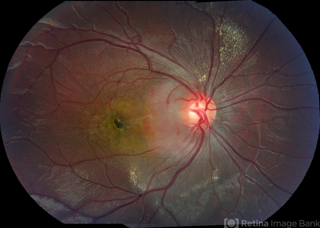 Optic Nerve/Retinal Capillary Hemangioma - Retina Image Bank