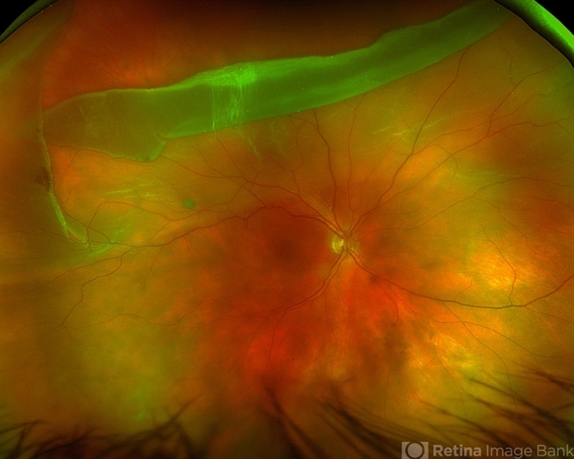 Giant Retinal Tear - Retina Image Bank