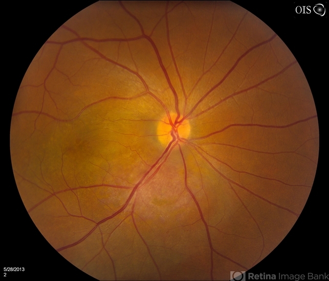 Cavernous Choroidal Hemangioma - Retina Image Bank