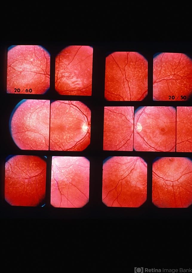 Flecks Rettine Fleck Retinopathy - Retina Image Bank