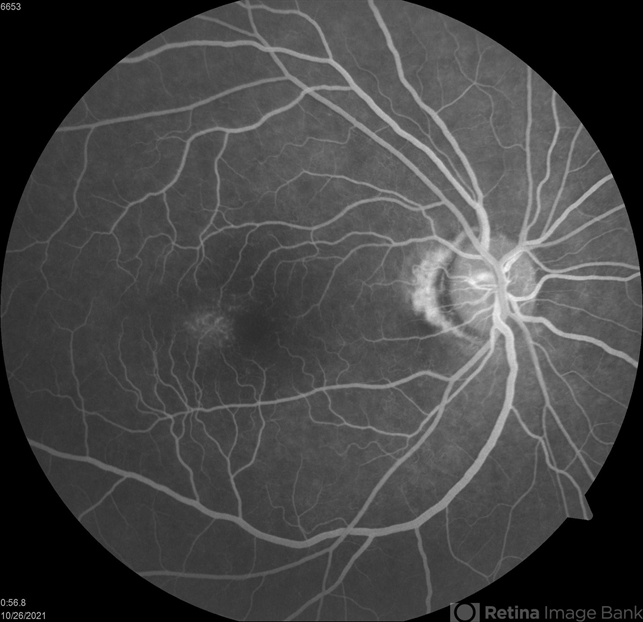 Macular telangiectasias, FA OD early - Retina Image Bank