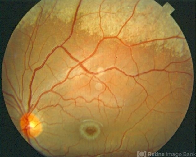 Niemann Pick Disease Type B - Retina Image Bank