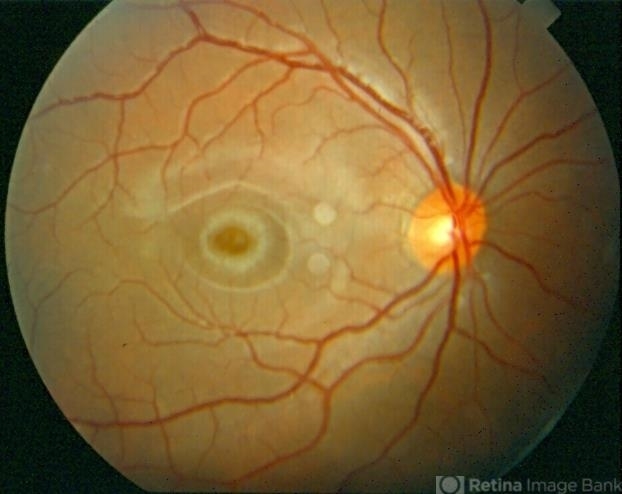 Niemann-Pick Disease, Types A and B