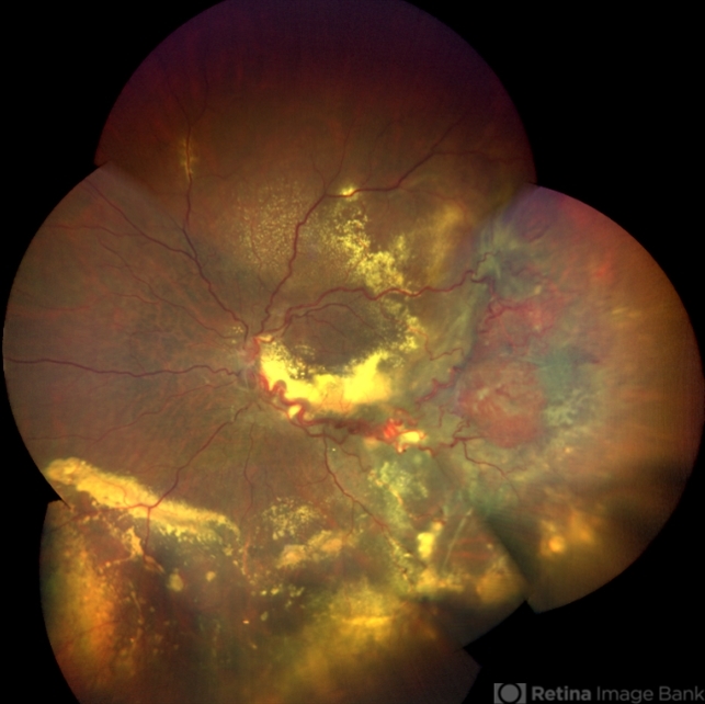 Retinal Capillary Hemangioblastoma - Retina Image Bank