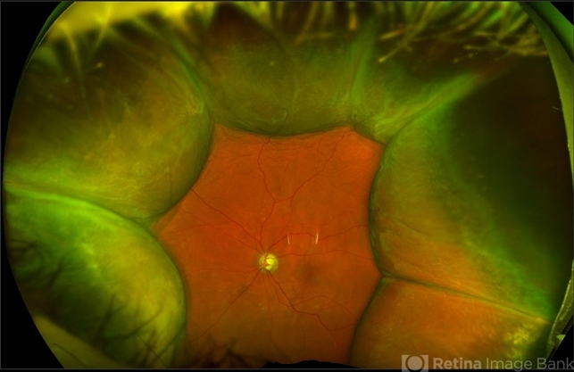 Choroidal Detachment - Retina Image Bank