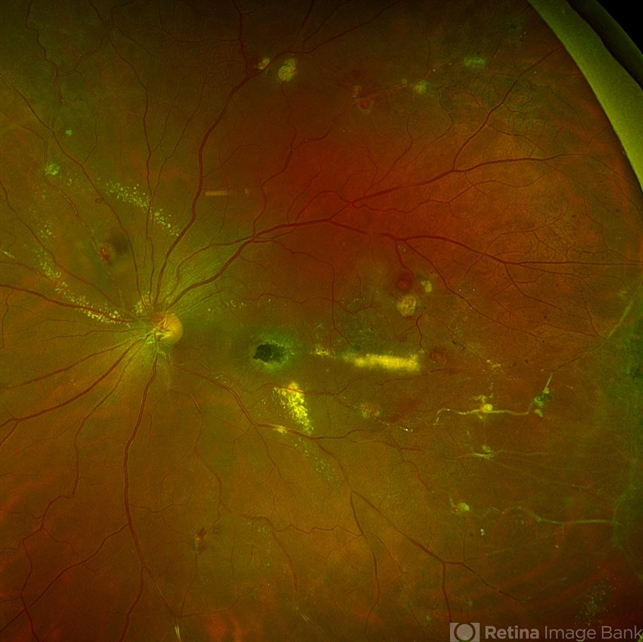 Coats Disease - Retina Image Bank