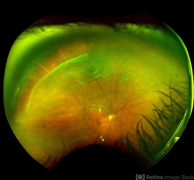 Giant Retinal Tear - Retina Image Bank