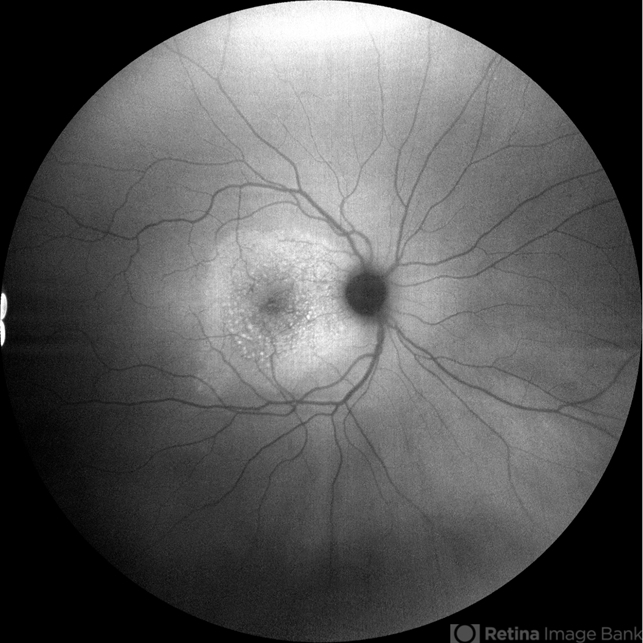 Acute syphilitic posterior placoid chorioretinitis - Retina Image Bank