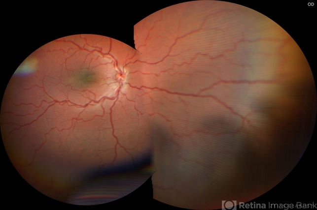 Wrightfields Eye Ultra-Widefield Right Eye Posterior Microphthalmos - Retina Image Bank