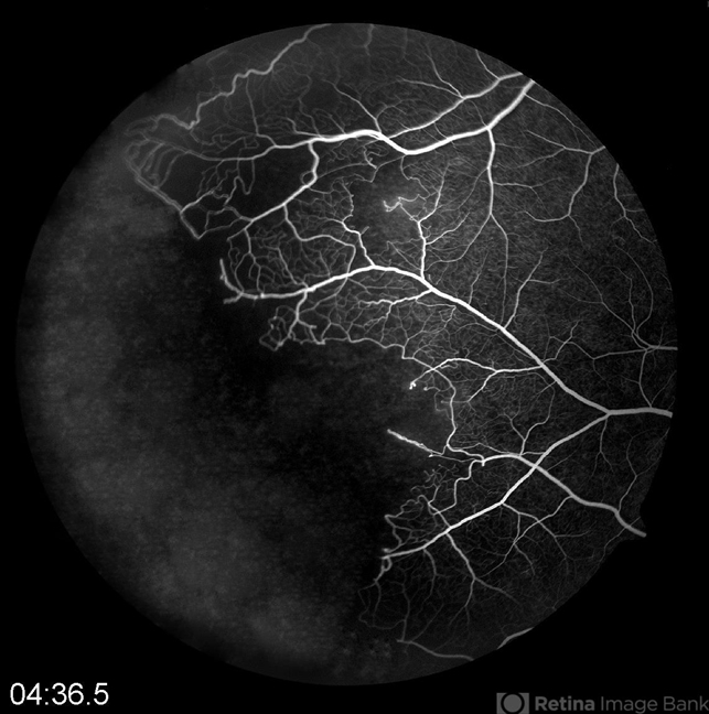 Sickle Cell Retinopathy - Retina Image Bank