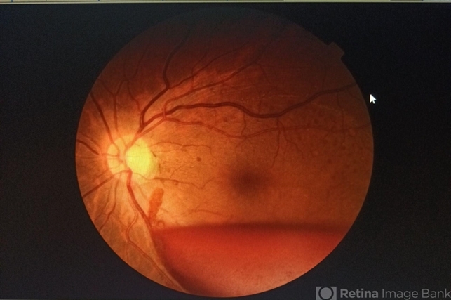 Sub Hyaloid Haemorrhage after Valsalva manoeuvre - Retina Image Bank