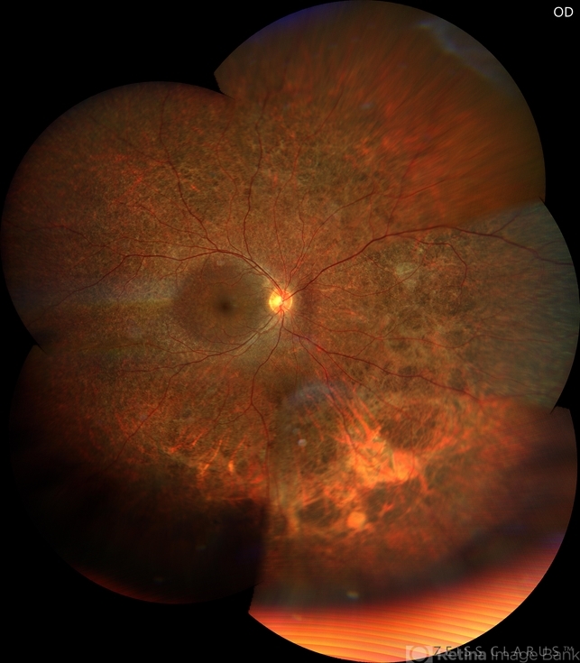 Retinitis pigmentosa - Retina Image Bank
