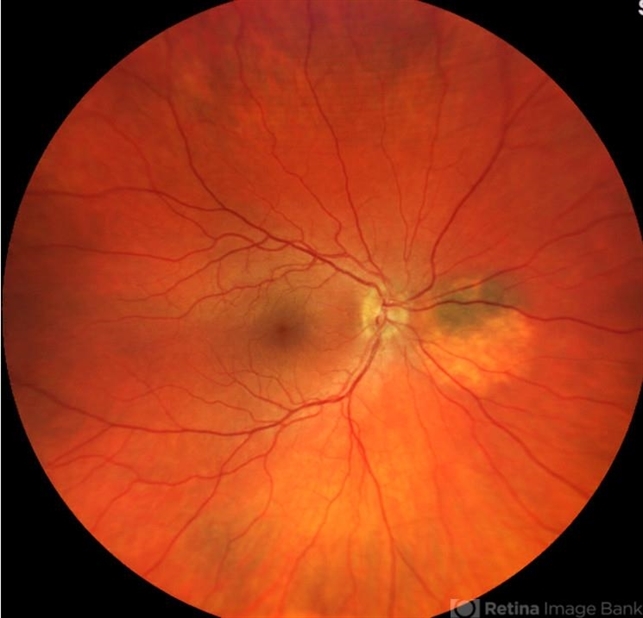 Choroidal nevus with halo - Retina Image Bank