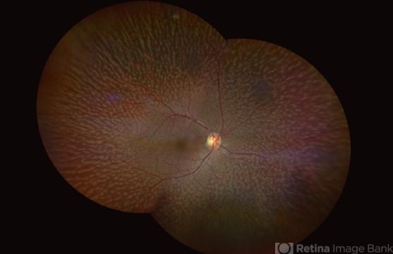 Fundus Albipunctatus Retina Image Bank