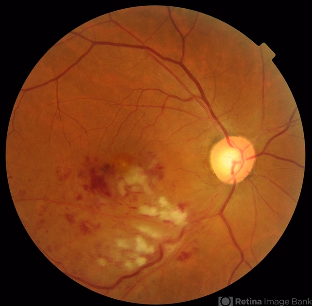 Non-perfused BRVO with macular infarction - Retina Image Bank