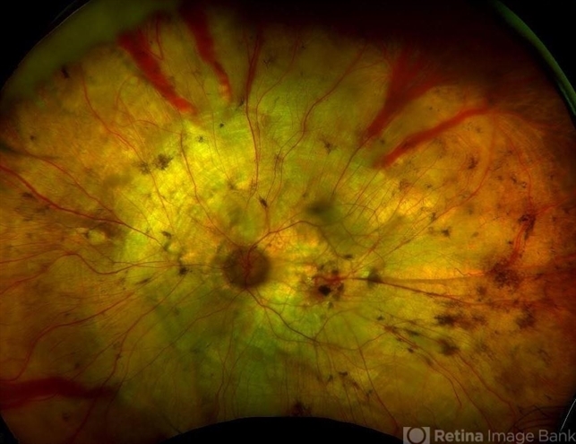 Choroideremia Retina Image Bank